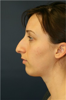 Rhinoplasty Before Photo by Steve Laverson, MD, FACS; Rancho Santa Fe, CA - Case 36735