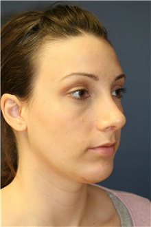 Rhinoplasty After Photo by Steve Laverson, MD, FACS; Rancho Santa Fe, CA - Case 36735