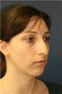 Rhinoplasty Before Photo by Steve Laverson, MD, FACS; Rancho Santa Fe, CA - Case 36735