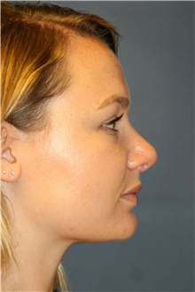 Rhinoplasty After Photo by Steve Laverson, MD, FACS; Rancho Santa Fe, CA - Case 36736