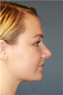 Rhinoplasty Before Photo by Steve Laverson, MD, FACS; Rancho Santa Fe, CA - Case 36736