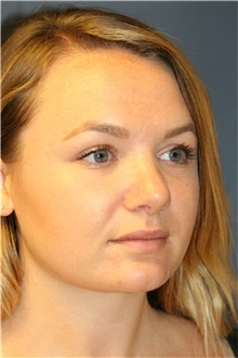 Rhinoplasty After Photo by Steve Laverson, MD, FACS; Rancho Santa Fe, CA - Case 36736