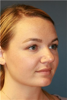 Rhinoplasty Before Photo by Steve Laverson, MD, FACS; Rancho Santa Fe, CA - Case 36736