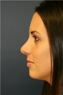 Rhinoplasty After Photo by Steve Laverson, MD, FACS; Rancho Santa Fe, CA - Case 36737