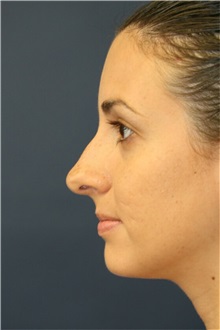 Rhinoplasty Before Photo by Steve Laverson, MD, FACS; Rancho Santa Fe, CA - Case 36737