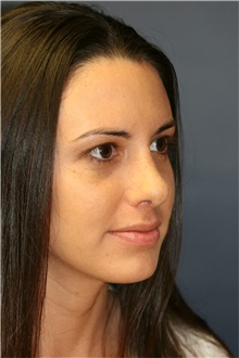 Rhinoplasty After Photo by Steve Laverson, MD, FACS; Rancho Santa Fe, CA - Case 36737