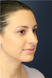 Rhinoplasty Before Photo by Steve Laverson, MD, FACS; Rancho Santa Fe, CA - Case 36737