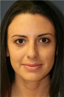 Rhinoplasty After Photo by Steve Laverson, MD, FACS; Rancho Santa Fe, CA - Case 36737