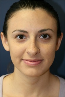 Rhinoplasty Before Photo by Steve Laverson, MD, FACS; Rancho Santa Fe, CA - Case 36737