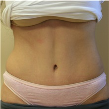 Tummy Tuck After Photo by Steve Laverson, MD, FACS; Rancho Santa Fe, CA - Case 36848