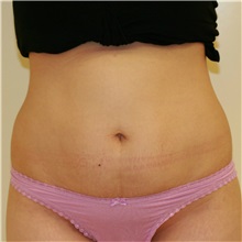 Tummy Tuck Before Photo by Steve Laverson, MD, FACS; Rancho Santa Fe, CA - Case 36848