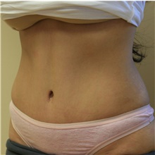 Tummy Tuck After Photo by Steve Laverson, MD, FACS; Rancho Santa Fe, CA - Case 36848