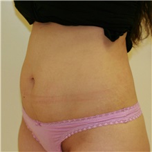 Tummy Tuck Before Photo by Steve Laverson, MD, FACS; Rancho Santa Fe, CA - Case 36848