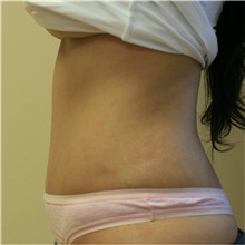 Tummy Tuck After Photo by Steve Laverson, MD, FACS; Rancho Santa Fe, CA - Case 36848