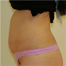 Tummy Tuck Before Photo by Steve Laverson, MD, FACS; Rancho Santa Fe, CA - Case 36848