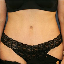 Tummy Tuck After Photo by Steve Laverson, MD, FACS; Rancho Santa Fe, CA - Case 36849