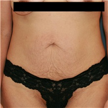 Tummy Tuck Before Photo by Steve Laverson, MD, FACS; Rancho Santa Fe, CA - Case 36849