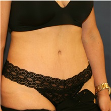 Tummy Tuck After Photo by Steve Laverson, MD, FACS; Rancho Santa Fe, CA - Case 36849