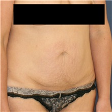 Tummy Tuck Before Photo by Steve Laverson, MD, FACS; Rancho Santa Fe, CA - Case 36849