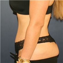 Tummy Tuck After Photo by Steve Laverson, MD, FACS; Rancho Santa Fe, CA - Case 36849