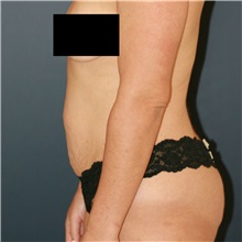 Tummy Tuck Before Photo by Steve Laverson, MD, FACS; Rancho Santa Fe, CA - Case 36849