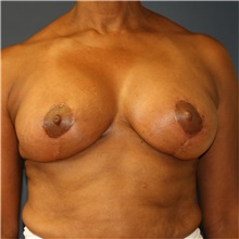 Breast Lift After Photo by Steve Laverson, MD, FACS; Rancho Santa Fe, CA - Case 36879