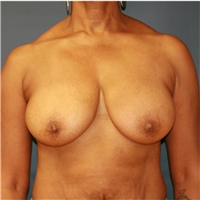 Breast Lift Before Photo by Steve Laverson, MD, FACS; Rancho Santa Fe, CA - Case 36879