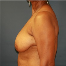 Breast Lift Before Photo by Steve Laverson, MD, FACS; Rancho Santa Fe, CA - Case 36879
