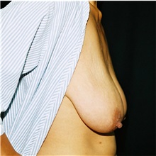 Breast Lift Before Photo by Steve Laverson, MD, FACS; San Diego, CA - Case 36882
