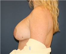 Breast Lift Before Photo by Steve Laverson, MD, FACS; Rancho Santa Fe, CA - Case 36883