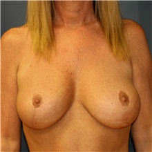 Breast Lift After Photo by Steve Laverson, MD; San Diego, CA - Case 36885