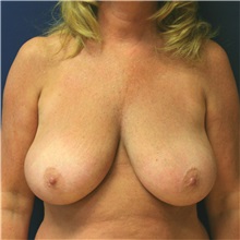 Breast Lift Before Photo by Steve Laverson, MD; San Diego, CA - Case 36885