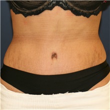 Tummy Tuck After Photo by Steve Laverson, MD, FACS; Rancho Santa Fe, CA - Case 37298