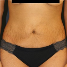 Tummy Tuck Before Photo by Steve Laverson, MD, FACS; Rancho Santa Fe, CA - Case 37298