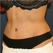 Tummy Tuck After Photo by Steve Laverson, MD, FACS; Rancho Santa Fe, CA - Case 37298