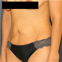 Tummy Tuck Before Photo by Steve Laverson, MD, FACS; Rancho Santa Fe, CA - Case 37298