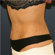 Tummy Tuck After Photo by Steve Laverson, MD, FACS; Rancho Santa Fe, CA - Case 37298