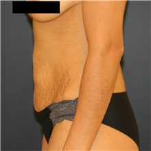 Tummy Tuck Before Photo by Steve Laverson, MD, FACS; Rancho Santa Fe, CA - Case 37298