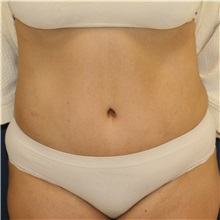 Tummy Tuck After Photo by Steve Laverson, MD, FACS; San Diego, CA - Case 37299