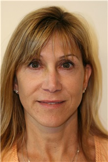 Facelift After Photo by Steve Laverson, MD, FACS; Rancho Santa Fe, CA - Case 37393