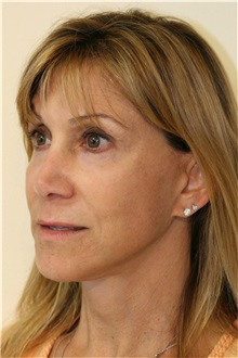 Facelift After Photo by Steve Laverson, MD, FACS; Rancho Santa Fe, CA - Case 37393