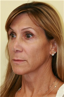 Facelift Before Photo by Steve Laverson, MD, FACS; Rancho Santa Fe, CA - Case 37393