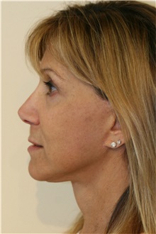 Facelift After Photo by Steve Laverson, MD, FACS; Rancho Santa Fe, CA - Case 37393