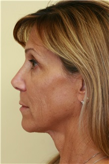 Facelift Before Photo by Steve Laverson, MD, FACS; Rancho Santa Fe, CA - Case 37393