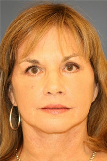 Facelift After Photo by Steve Laverson, MD; San Diego, CA - Case 37394