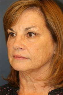 Facelift Before Photo by Steve Laverson, MD, FACS; San Diego, CA - Case 37394