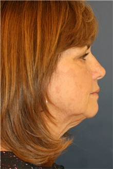 Facelift Before Photo by Steve Laverson, MD, FACS; San Diego, CA - Case 37394