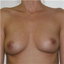 Breast Augmentation Before Photo by Steve Laverson, MD, FACS; Rancho Santa Fe, CA - Case 37467