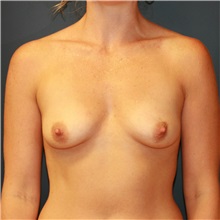 Breast Augmentation Before Photo by Steve Laverson, MD, FACS; San Diego, CA - Case 37471