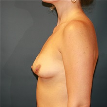 Breast Augmentation Before Photo by Steve Laverson, MD, FACS; Rancho Santa Fe, CA - Case 37471